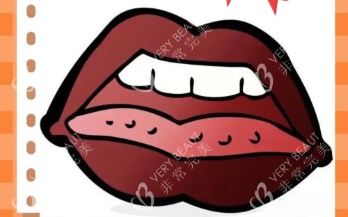 嘴唇发黑示意图1 嘴唇发黑示意图1