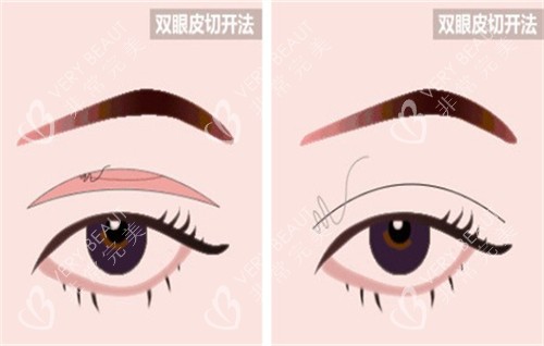 全切双眼皮手术的切口部位 全切双眼皮手术的切口部位