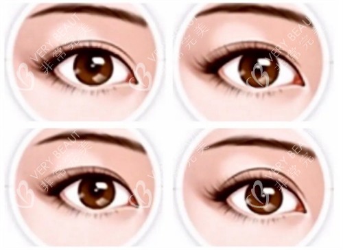 不同双眼皮形态参考图 不同双眼皮形态参考图