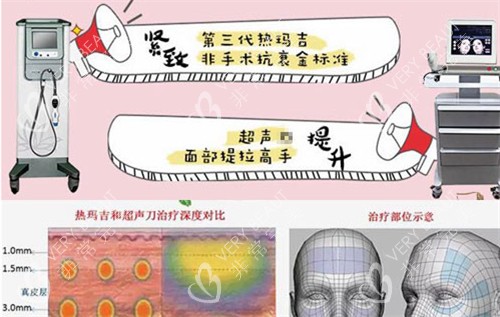 热玛吉与超声仪器抗衰的作用图解 热玛吉与超声仪器抗衰的作用图解