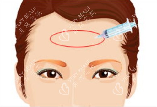 填充额头术玻尿酸注射动画图 填充额头术玻尿酸注射动画图