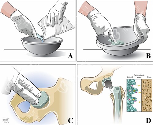 骨水泥修补过程 骨水泥修补过程