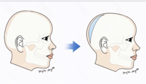 骨水泥填充后脑勺 骨水泥填充后脑勺