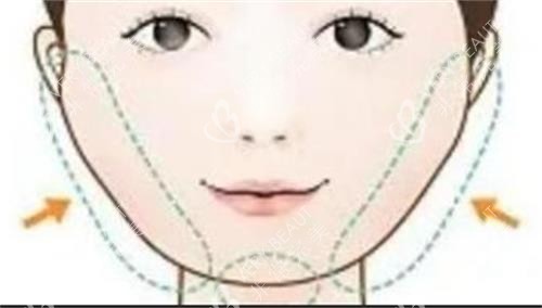 磨骨手术的部位 磨骨手术的部位