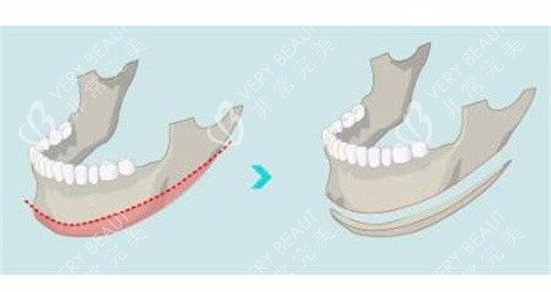 磨骨手术 磨骨手术