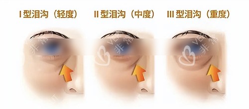 泪沟类型 泪沟类型