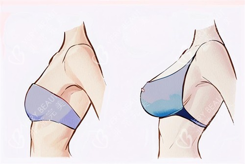 假体隆胸的前后对比图