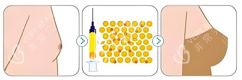 自体脂肪隆胸对比 自体脂肪隆胸对比