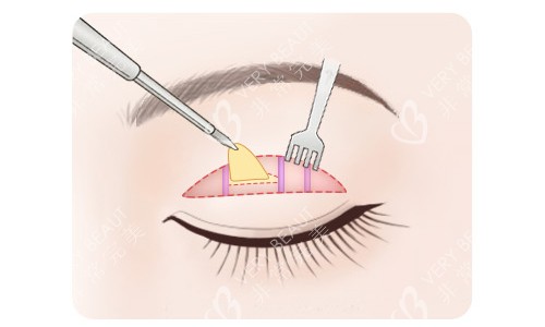 全切双眼皮脂肪切除 全切双眼皮脂肪切除
