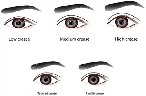 不同类型的双眼皮 不同类型的双眼皮