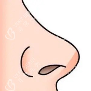 隆鼻手术的示意图 隆鼻手术的示意图