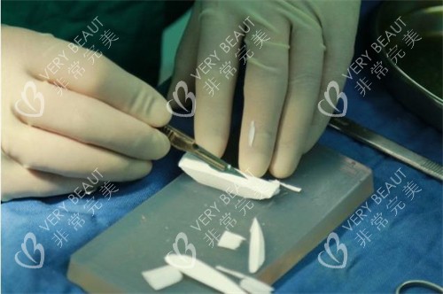 隆鼻手术正在雕刻的膨体 隆鼻手术正在雕刻的膨体