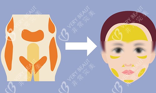 男性增大增粗手术 男性增大增粗手术