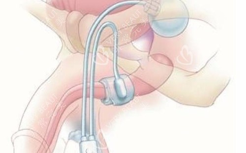 男性私密整形勃起治疗卡通示意图 男性私密整形勃起治疗卡通示意图