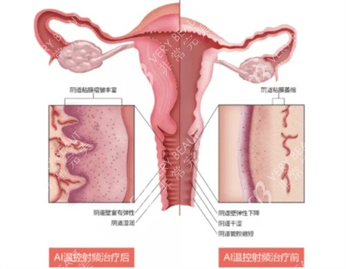 半岛FemeTite私密热玛吉功效 半岛FemeTite私密热玛吉功效