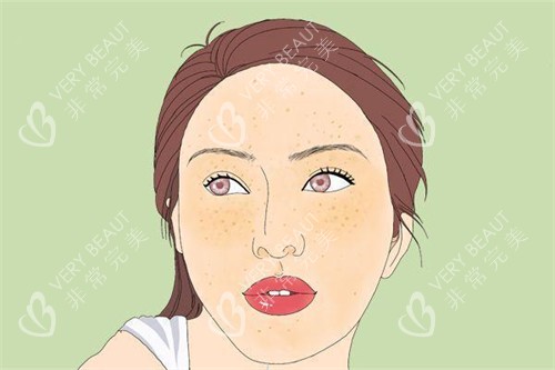 黄褐斑卡通图片展示 黄褐斑卡通图片展示