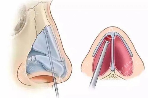 隆鼻卡通示意图展示 隆鼻卡通示意图展示