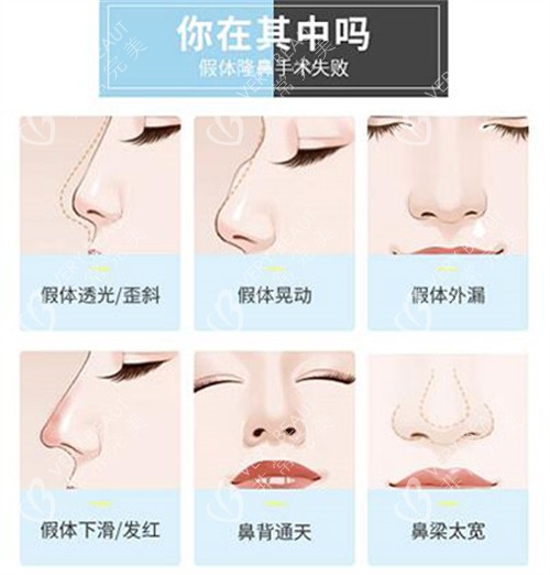 哪些鼻子需要做修复改善 哪些鼻子需要做修复改善