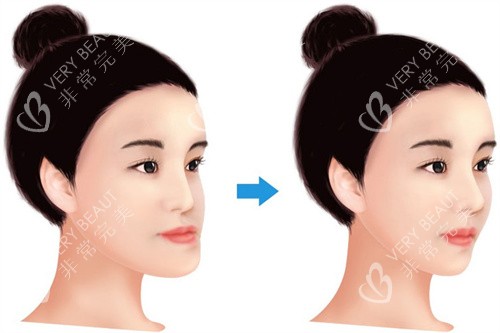 牙齿反颌面型差异 牙齿反颌面型差异