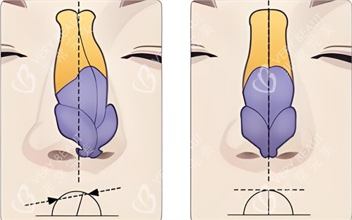 歪鼻矫正术对比图 歪鼻矫正术对比图