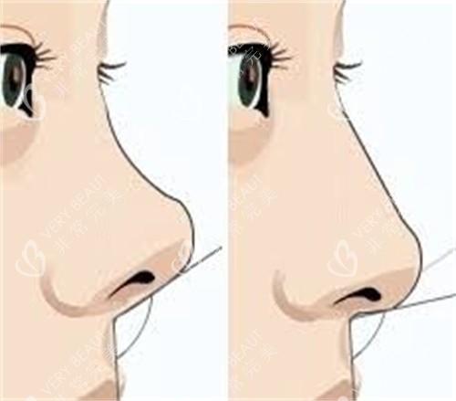 隆鼻手术膨体隆鼻前后对比 隆鼻手术膨体隆鼻前后对比