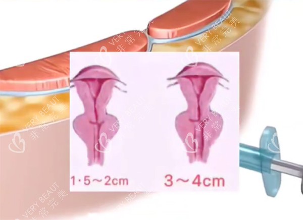 紧缩针对比动画*** 紧缩针对比动画***