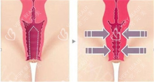 私密紧缩手术前后对比差异 私密紧缩手术前后对比差异