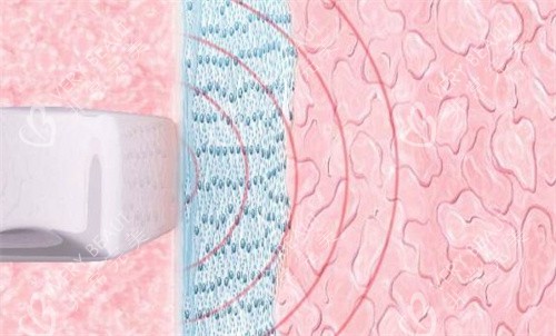 阴道紧缩原理 阴道紧缩原理