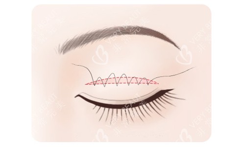 全切双眼皮缝合