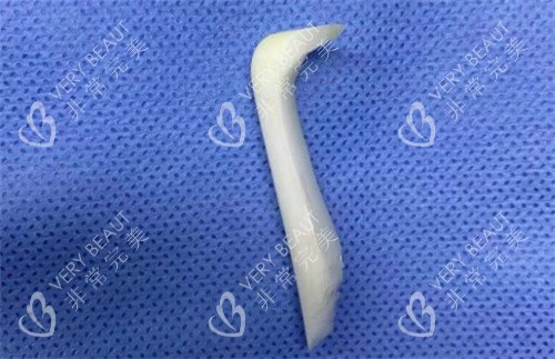 取出的隆鼻假体