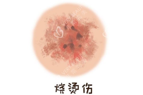 皮肤烫伤疤卡通图 皮肤烫伤疤卡通图