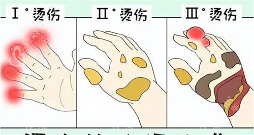 烧烫伤等级动画图 烧烫伤等级动画图