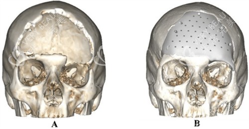 peek修复颅骨前后对比 peek修复颅骨前后对比