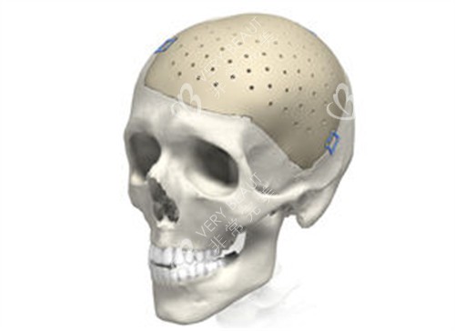 peek修补颅骨 peek修补颅骨