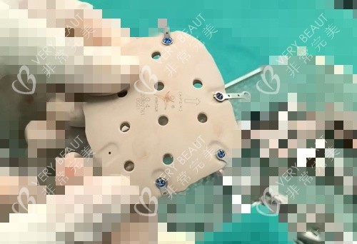 PEEK材料示意图 PEEK材料示意图