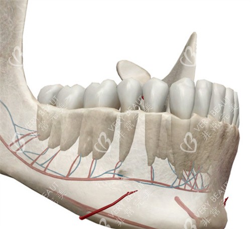 正颌手术模型 正颌手术模型