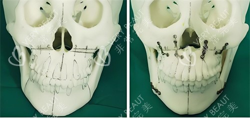 正颌手术手术原理展示图 正颌手术手术原理展示图