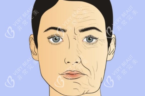 面部衰老提升卡通对比图 面部衰老提升卡通对比图