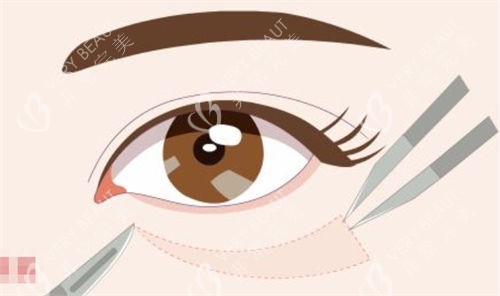 去眼袋手术示意图