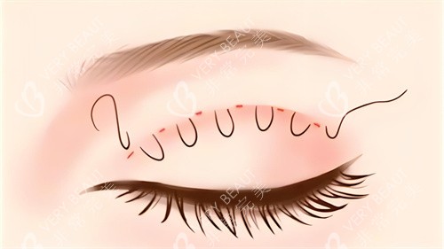 双眼皮埋线图 双眼皮埋线图