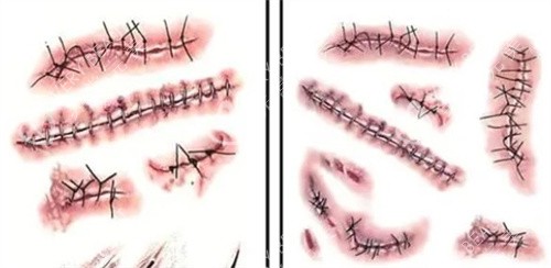 不同的手术疤痕