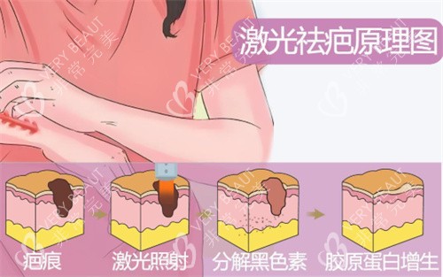 激光祛疤原理示图