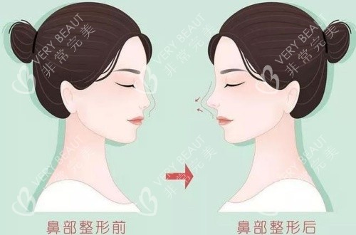 隆鼻术后漫画示意图