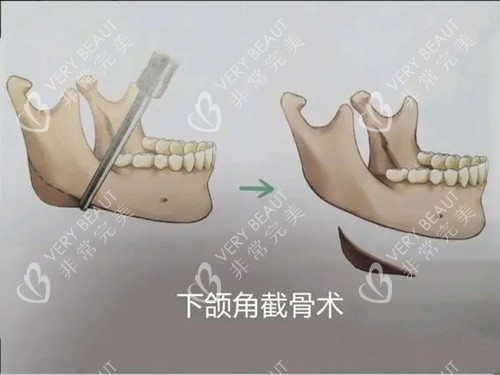 下颌角截骨术卡通示意图