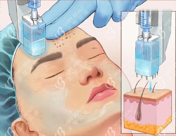 面部水光注射照片