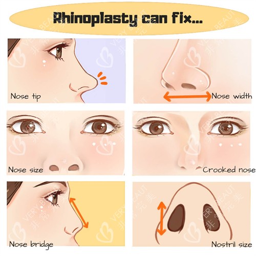 鼻修复流程一览图 鼻修复流程一览图
