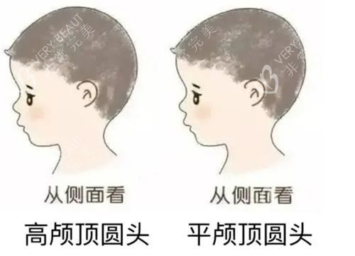 高颅顶和正常头的对比 高颅顶和正常头的对比