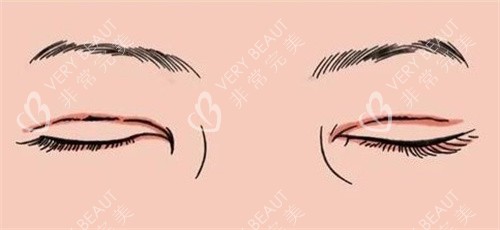 双眼皮疤痕修复 双眼皮疤痕修复