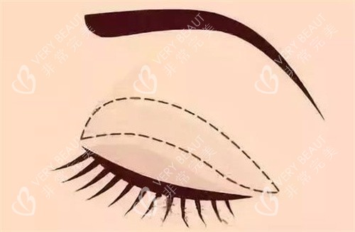 全切双眼皮 全切双眼皮