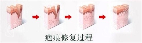 疤痕修复过程图